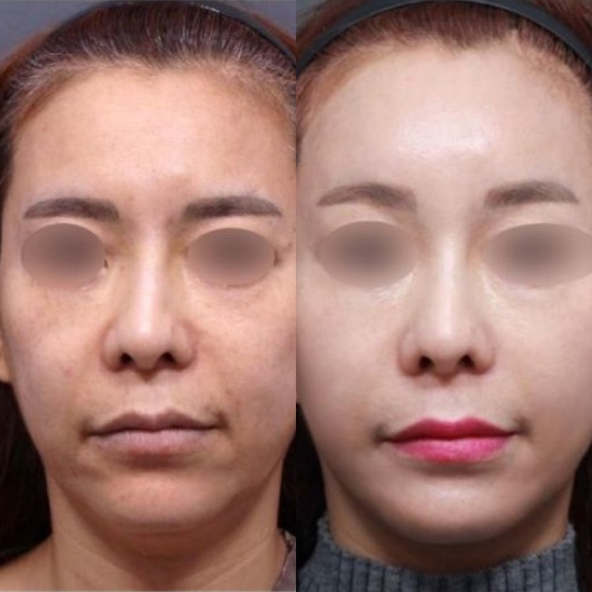 Before and after endoscopic facelift results at Returning Plastic Surgery, facial rejuvenation