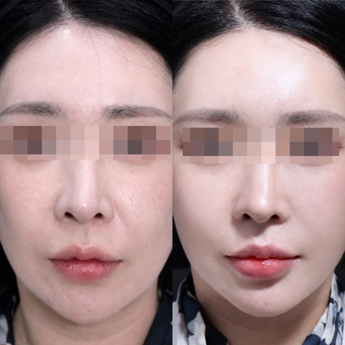 Before and after endoscopic facelift results at Returning Plastic Surgery, facial rejuvenation
