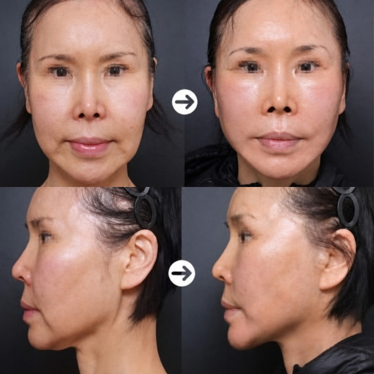 نتائج شد الوجه بالمنظار قبل وبعد في VG Plastic Surgery، تجديد شباب الوجه واضح
