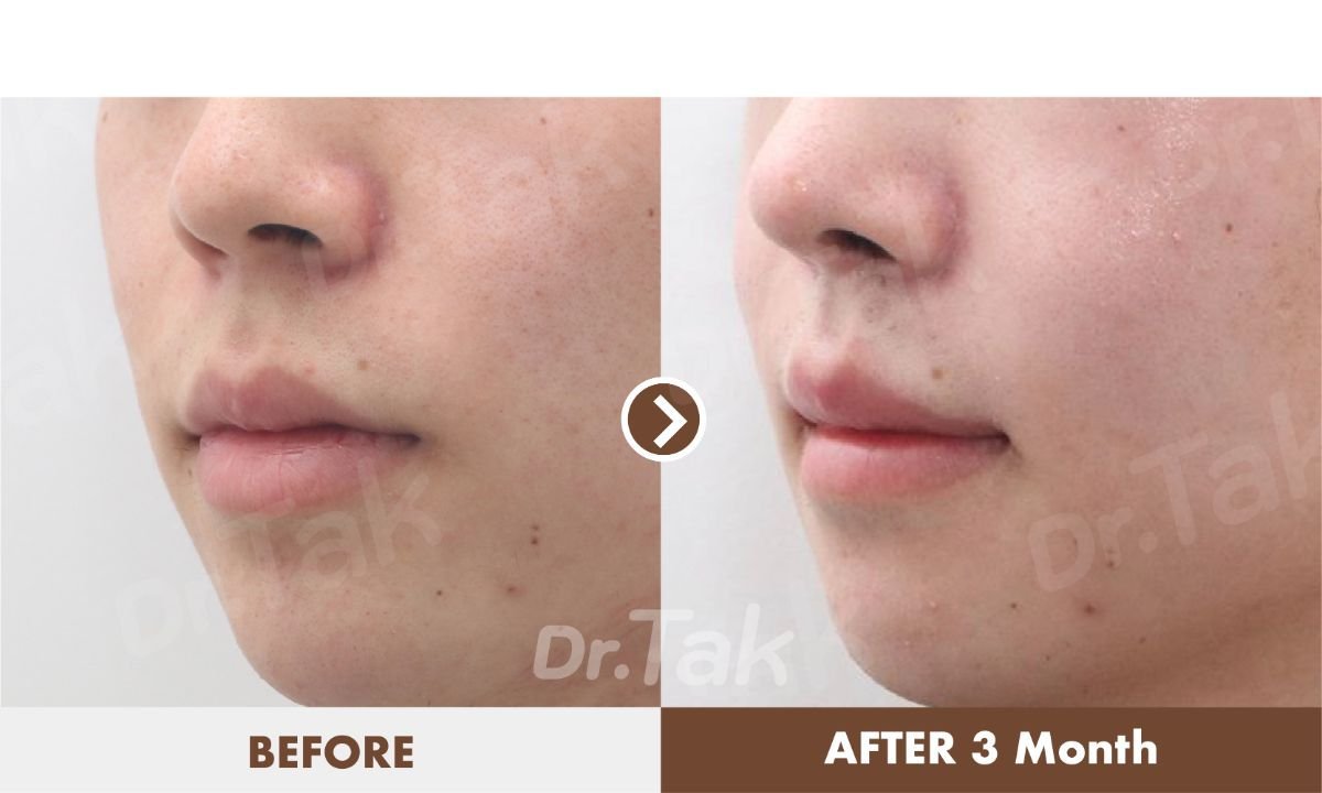 Before and after lip reduction results at Dr. Tak Plastic Surgery, visible slimmer lips