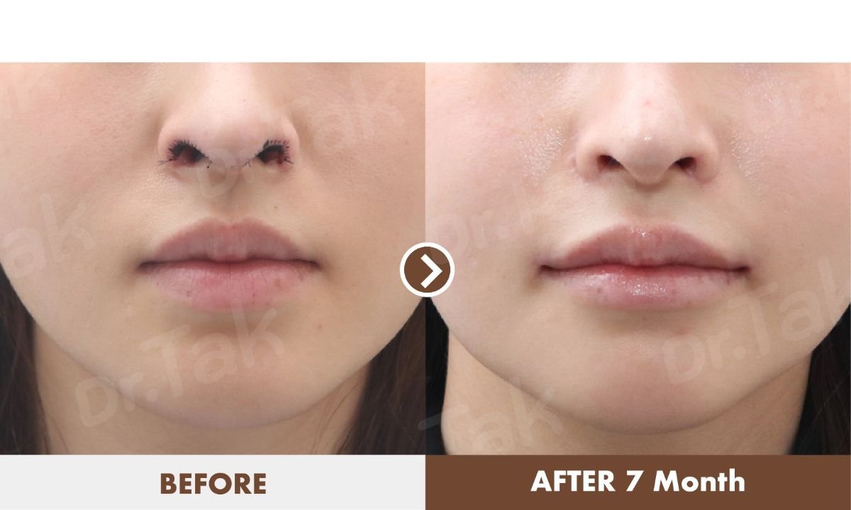 Resultados de reducción de labios antes y después en Dr. Tak Plastic Surgery, 7 meses