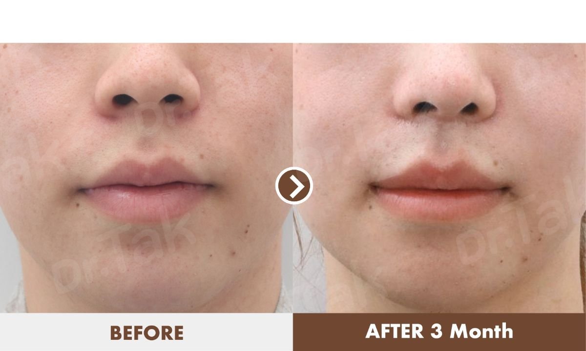 Vorher-nachher-Ergebnis der Lippenverkleinerung bei Dr. Tak Plastic Surgery, schlankere Lippen nach 3 Monaten