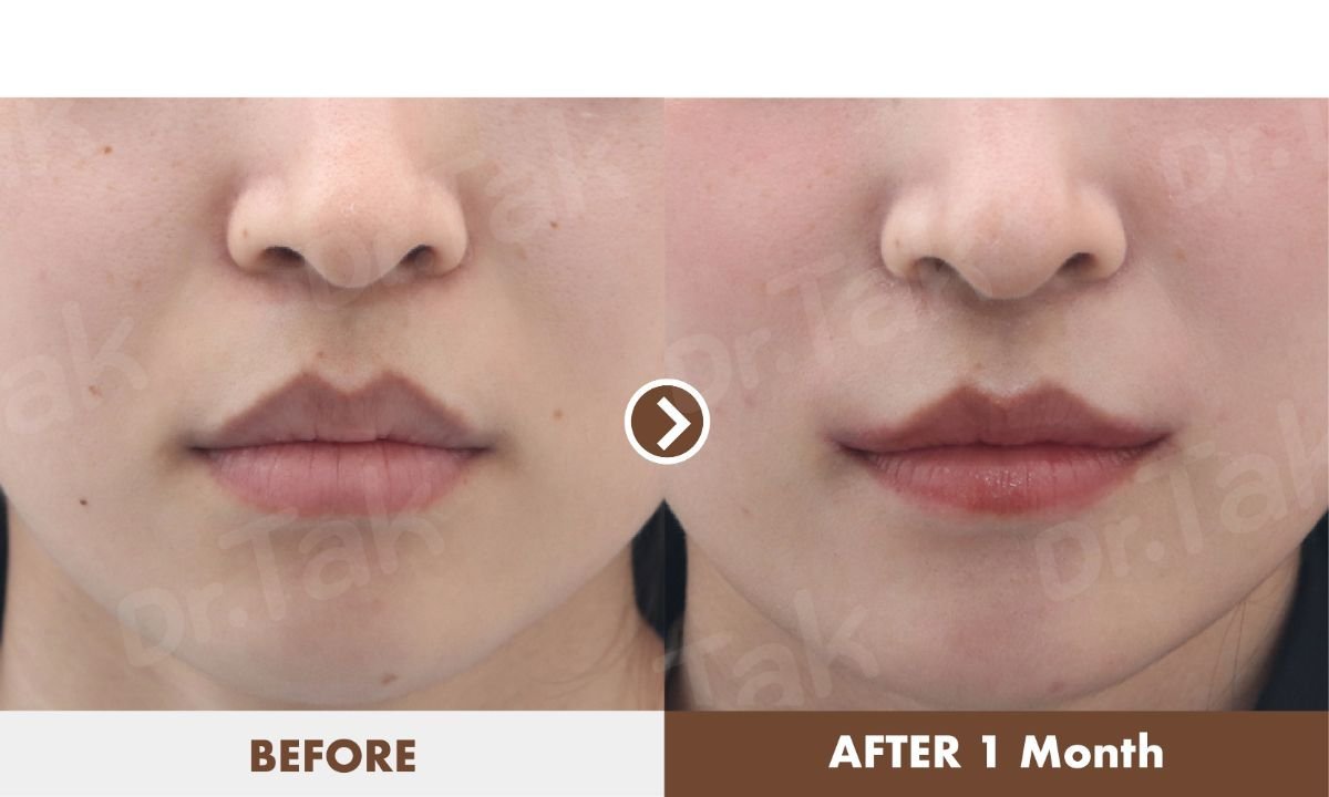 Before and after lip reduction results at Dr. Tak Plastic Surgery, visible slimmer lips outcome