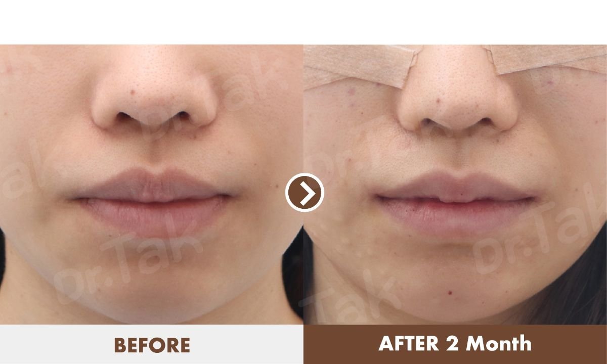 Resultados de reducción de labios antes y después en Dr. Tak Plastic Surgery, labios más delgados