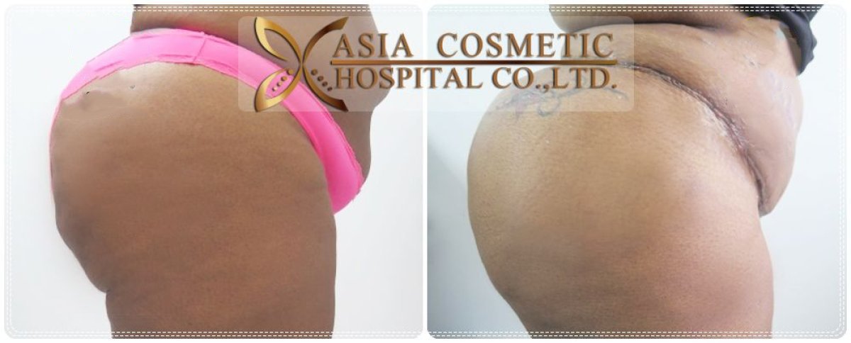 Before and after Brazilian Butt Lift results at Asia Cosmetic Hospital, enhanced buttock contour