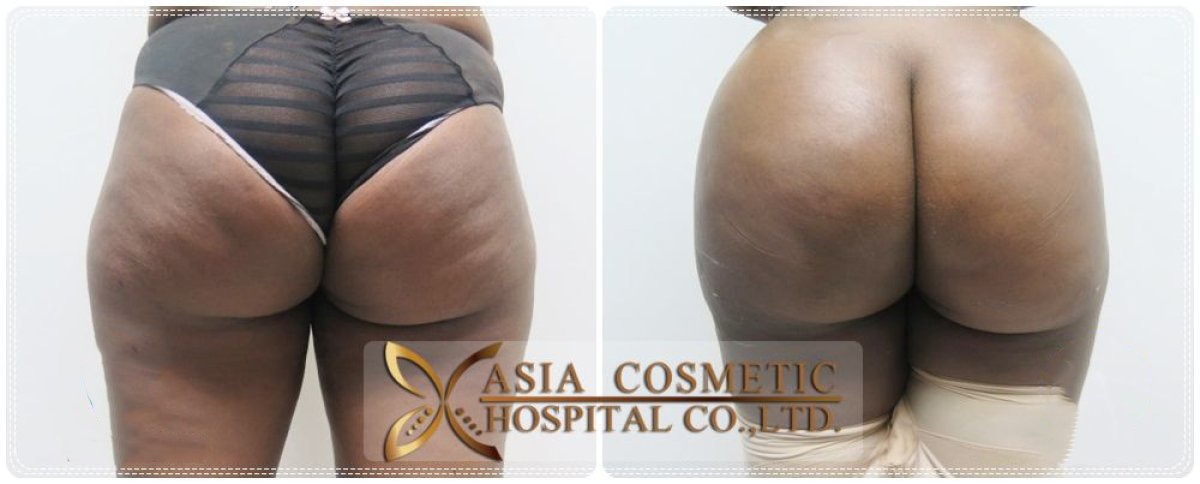 Before and after Brazilian Butt Lift results at Asia Cosmetic Hospital, enhanced buttock contour