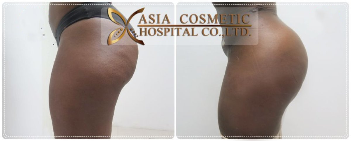 Before and after Brazilian Butt Lift results at Asia Cosmetic Hospital, enhanced buttock contour