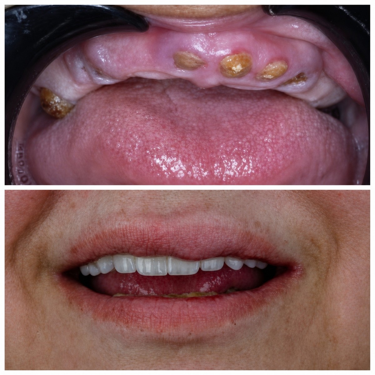 نتيجة قبل وبعد زراعة أسنان زركونيا All-on-4 في Omara Dental Centers
