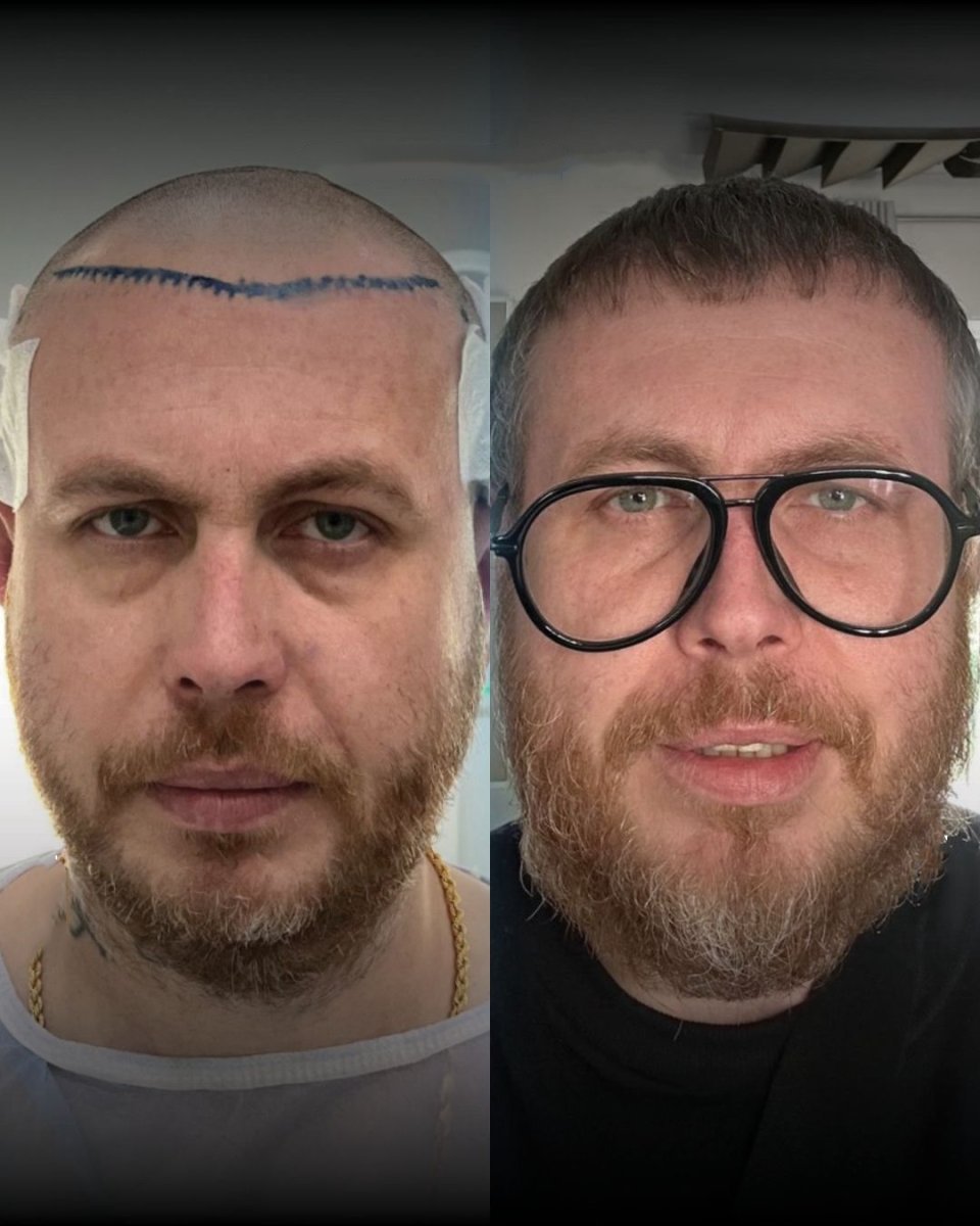 Before and after FUE hair transplant results at Men's Health Clinics, restored fuller hairline