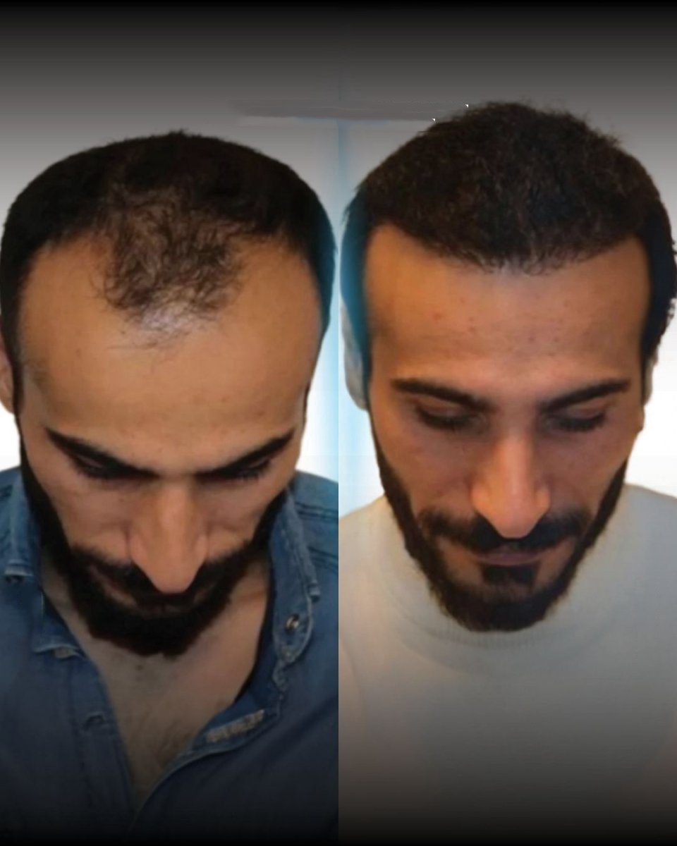 نتائج قبل وبعد زراعة الشعر FUE في Men's Health Clinics، كثافة شعر محسنة
