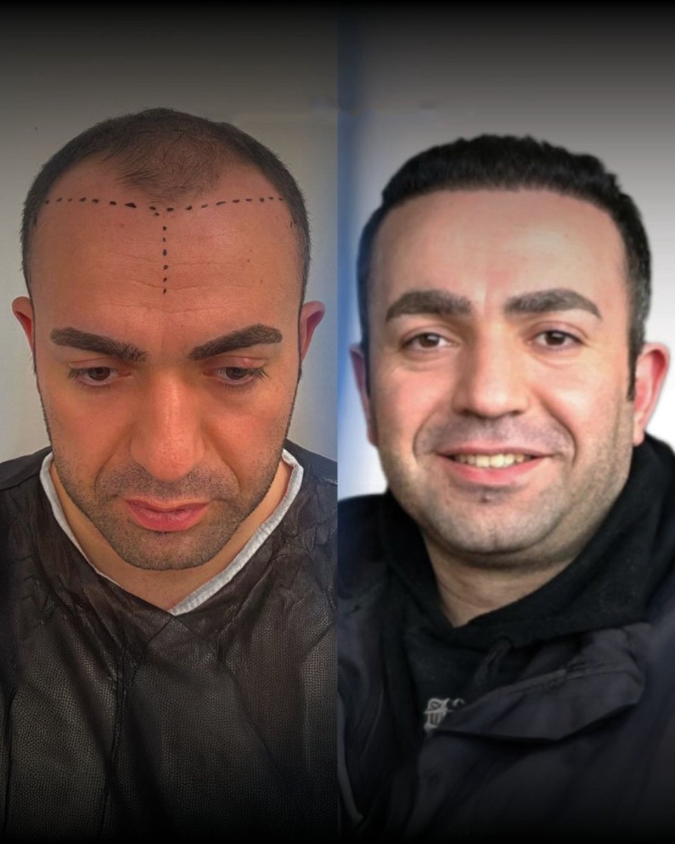 نتيجة قبل وبعد زراعة الشعر FUE في Men's Health Clinics، استعادة خط الشعر للرجال