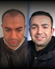 FUE Hair Transplant — 5000 Grafts & 4★ Hotel, 3 Nights - photo 5