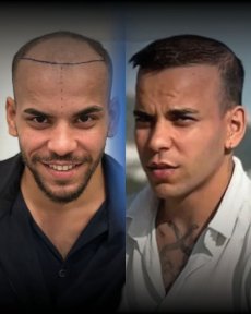 FUE Hair Transplant — 5000 Grafts & 4★ Hotel, 3 Nights - photo 4