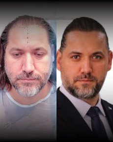 DHI Hair Transplant — 5500 Grafts & PRP Session Included - photo 4