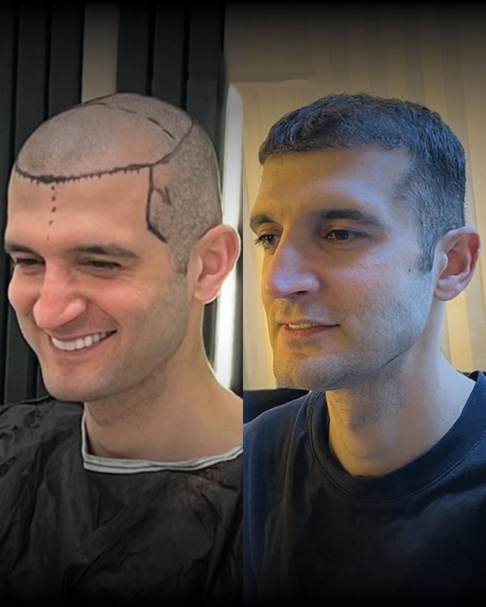 Before and after DHI hair transplant results at Men's Health Clinics, restored natural hairline