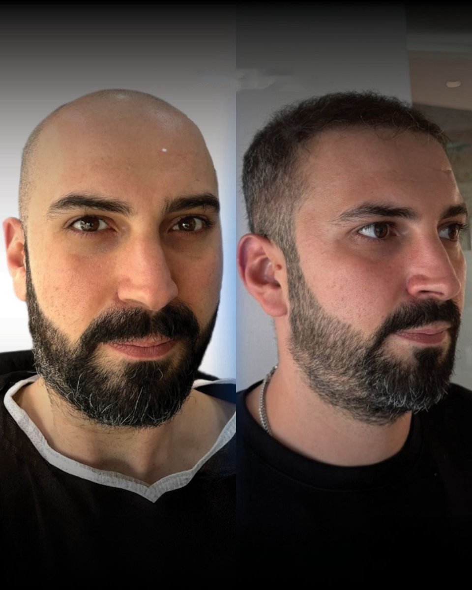 Before and after DHI hair transplant results at Men's Health Clinics, restored natural hairline