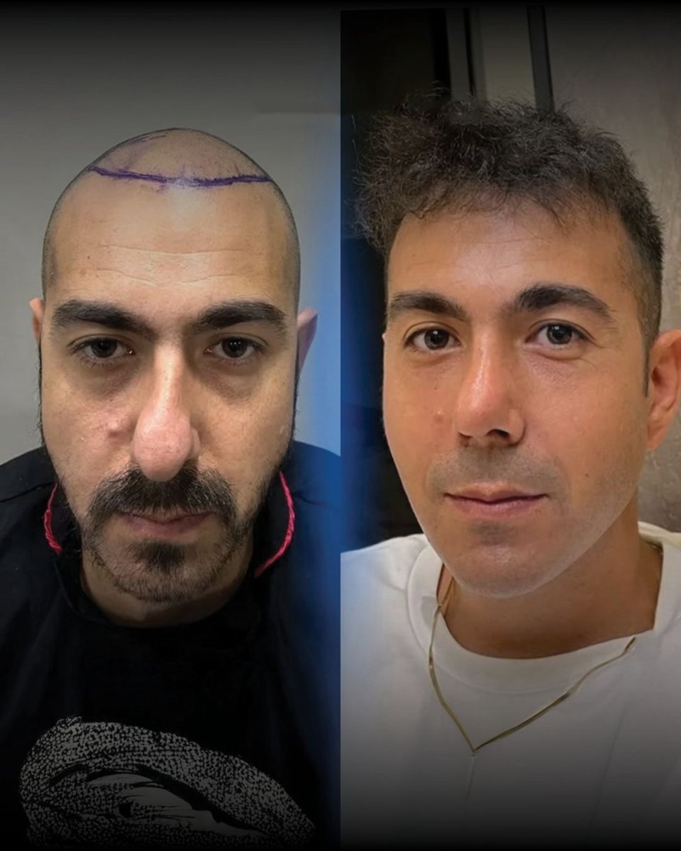Résultats avant/après greffe de cheveux DHI chez Men's Health Clinics, ligne restaurée