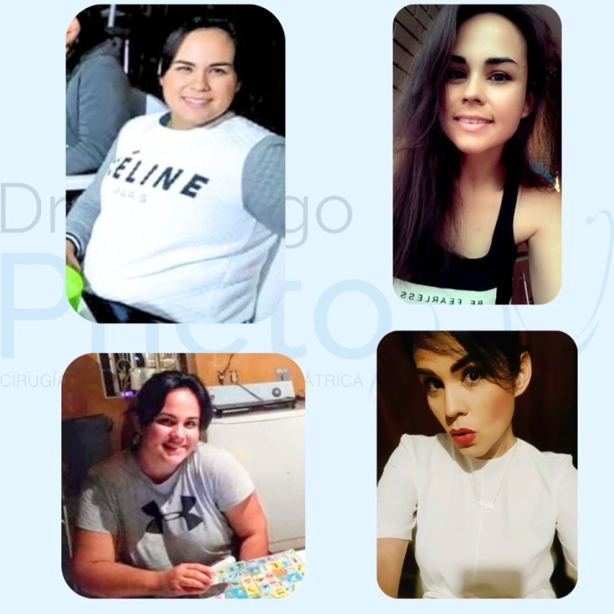 Resultados antes y después de manga gástrica en Dr. Rodrigo Prieto Bariatric Center, México