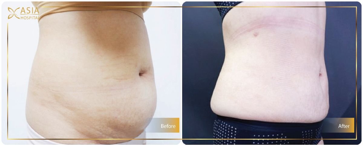 Before and after Vaser liposuction results at Asia Cosmetic Hospital, abdomen contour improved