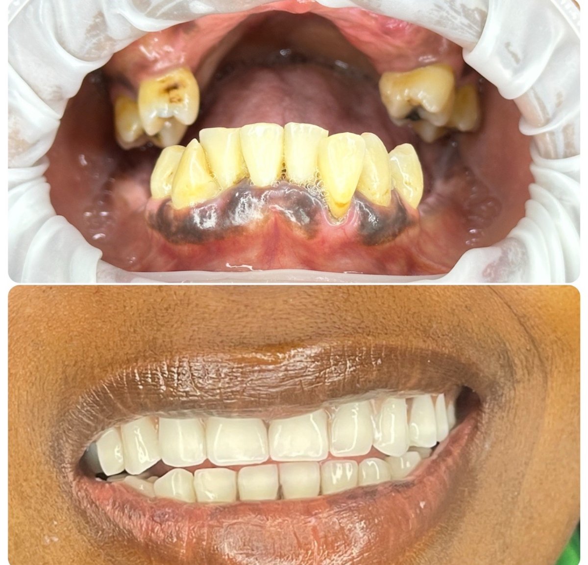Before and after All-on-6 dental implants result at Love Dental and Sthetic Clinic, smile restoration