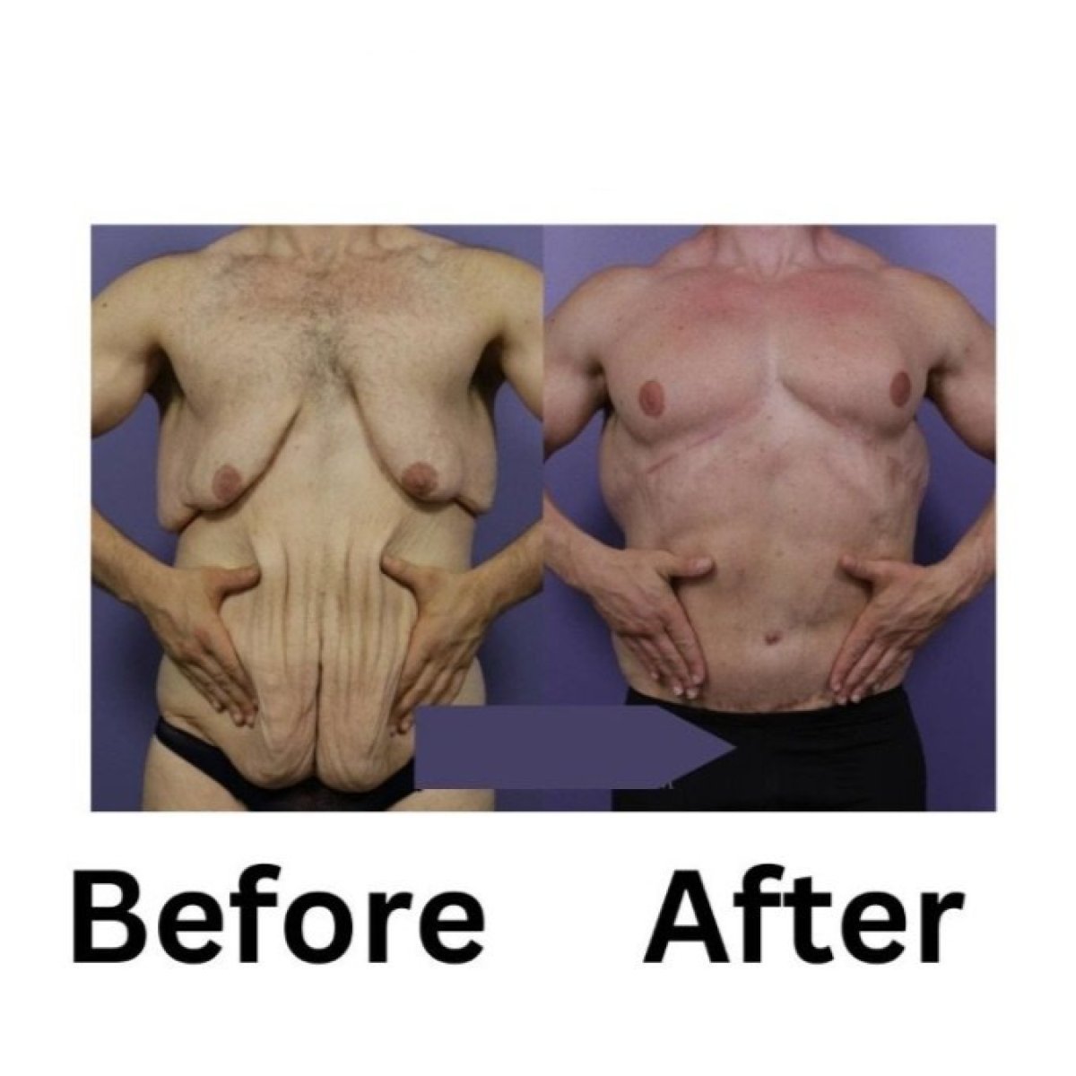 Before and after tummy tuck results at ID Clinic Bangkok – improved abdominal contour in male