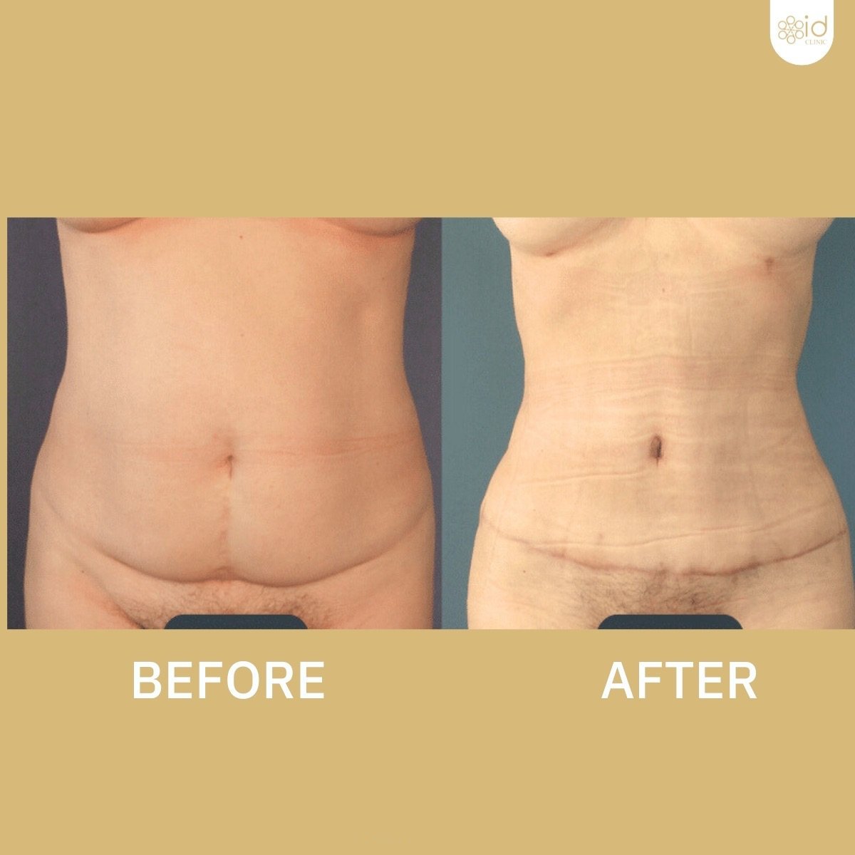 Before and after tummy tuck results at ID Clinic Bangkok, improved abdominal contour