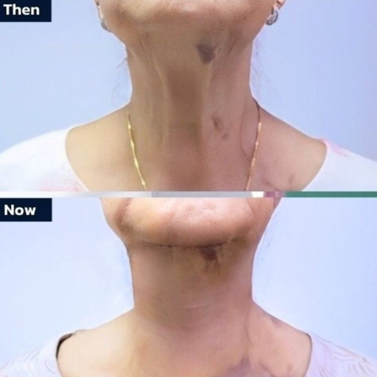 Before and after neck lift results at Asia Cosmetic Hospital, visible skin tightening improvement