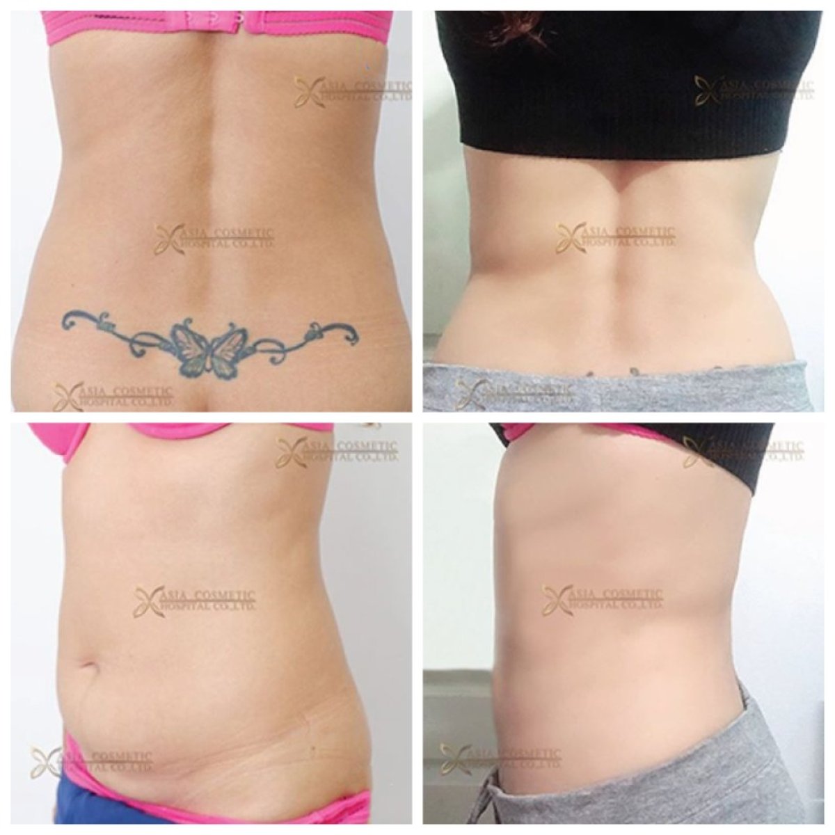 Before and after Vaser liposuction results at Asia Cosmetic Hospital, visible waist contouring