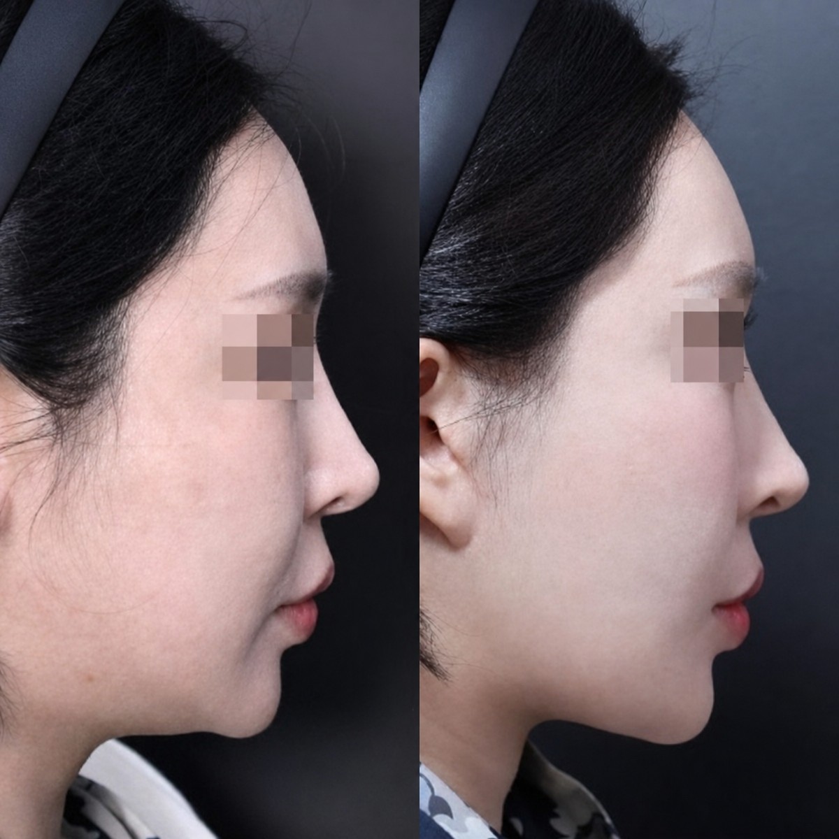 Resultados de cirugía de feminización facial antes y después en Returning Plastic Surgery, perfil