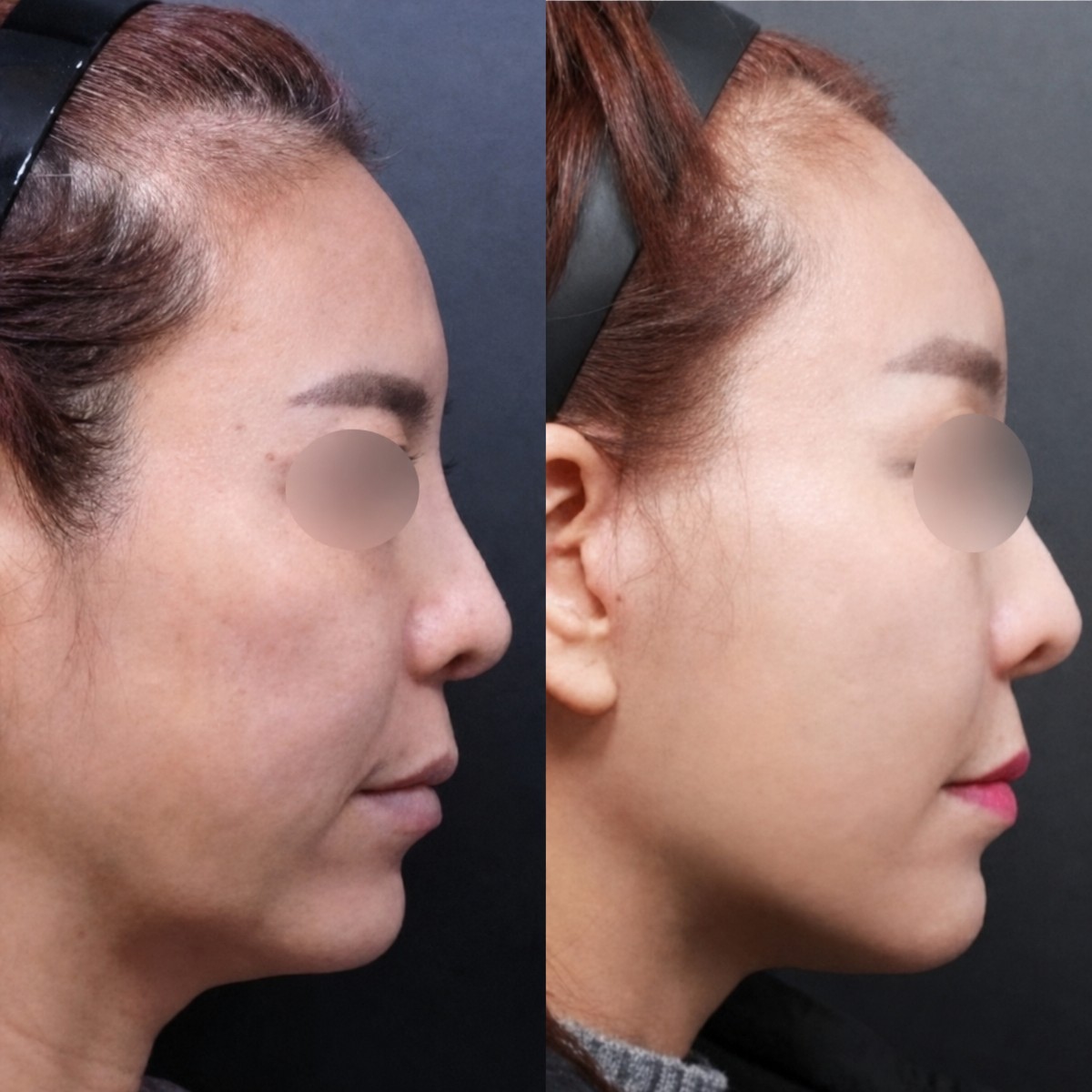 Before and after facial feminization surgery results at Returning Plastic Surgery, softer profile