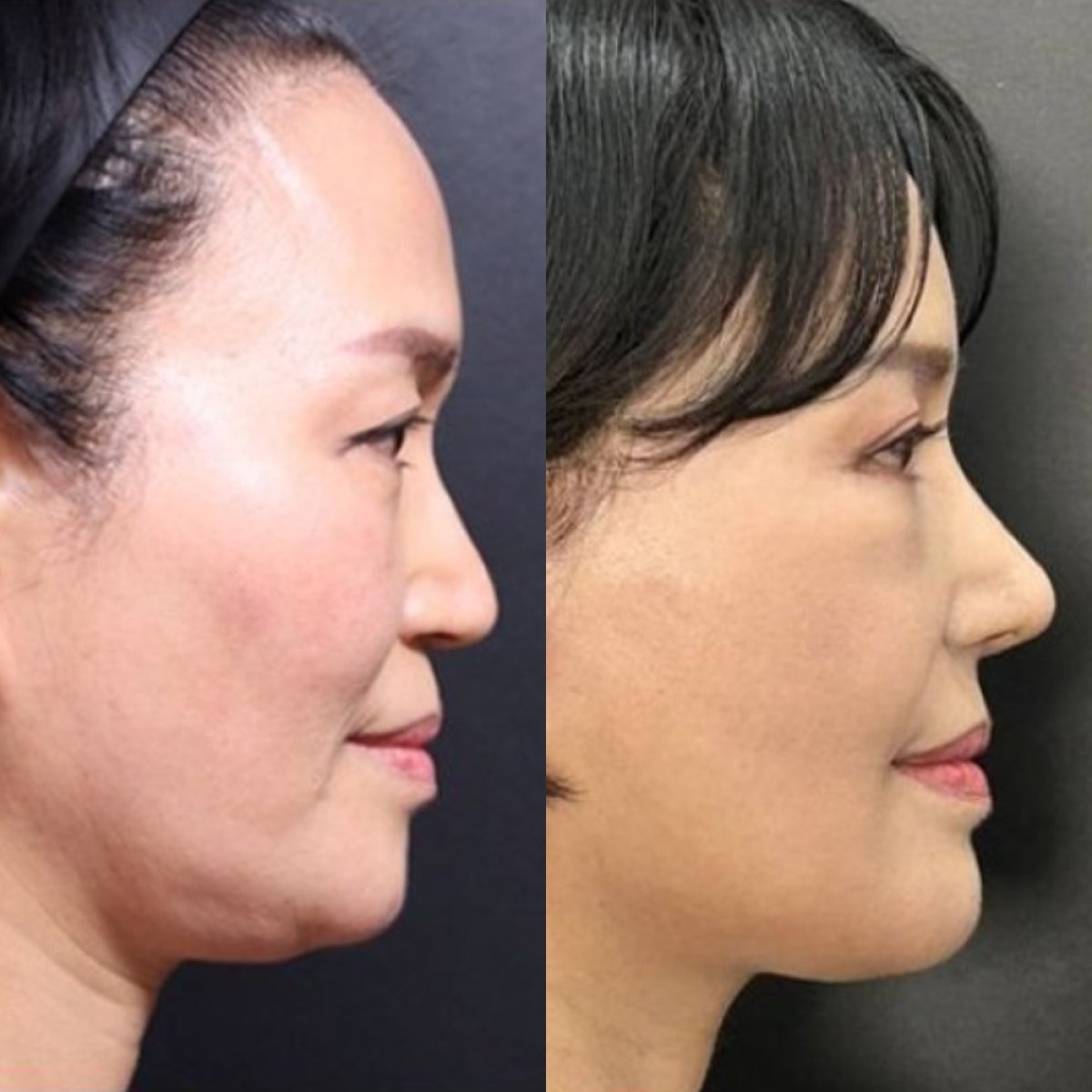 نتائج جراحة تأنيث الوجه قبل وبعد في Returning Plastic Surgery، تحديد الفك بشكل أنعم