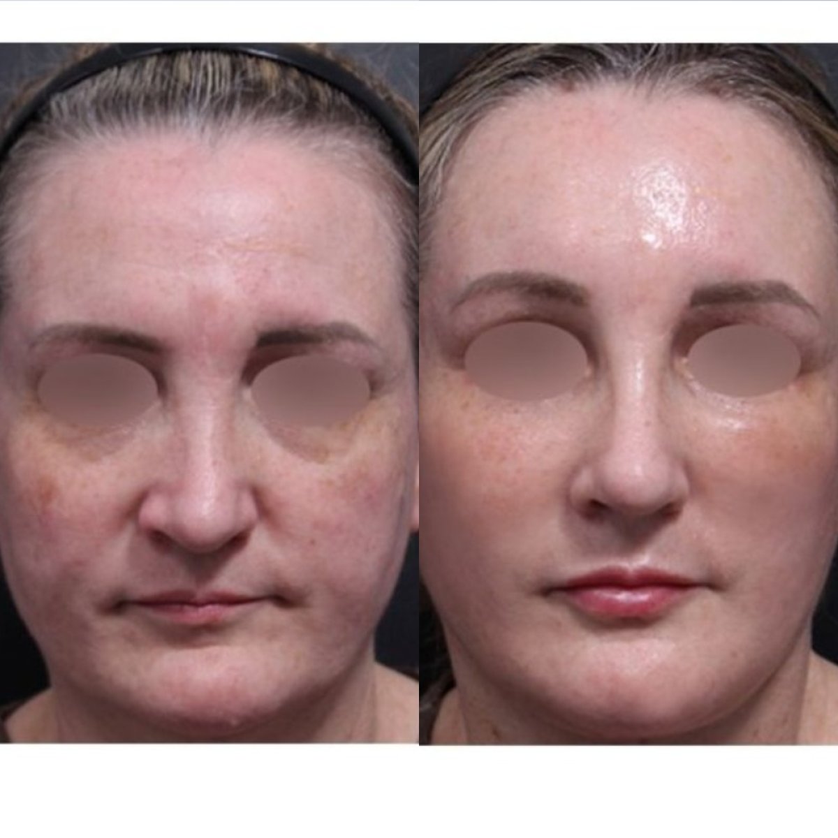 نتائج جراحة تأنيث الوجه قبل وبعد في Returning Plastic Surgery، ملامح أكثر نعومة