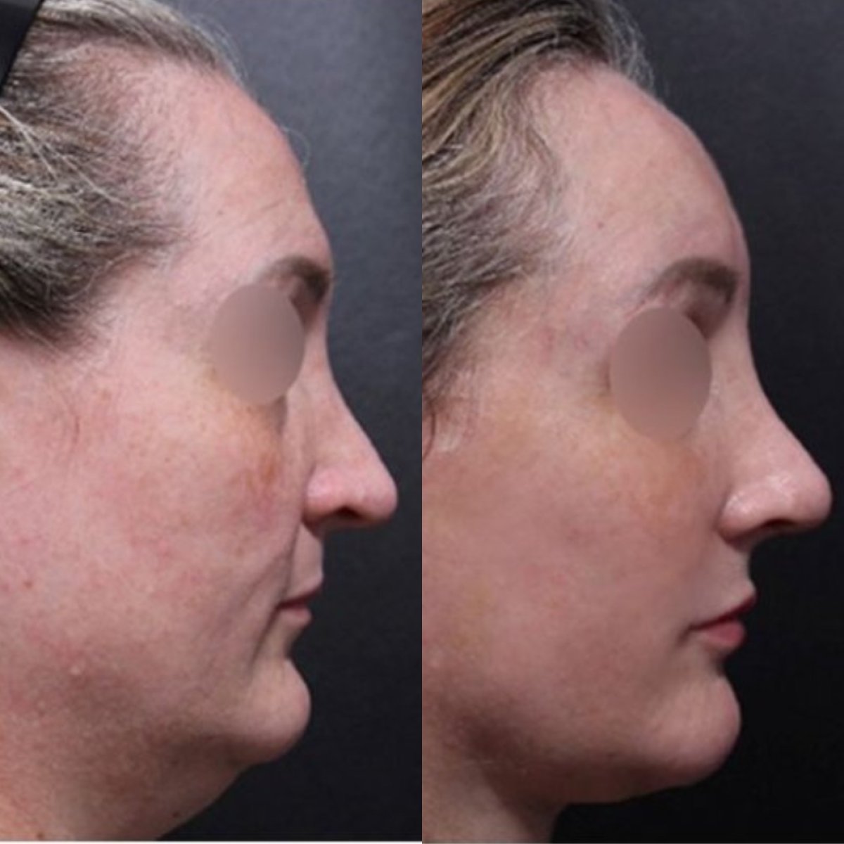 Результати фемінізуючої пластики обличчя до і після в Returning Plastic Surgery, витончений профіль