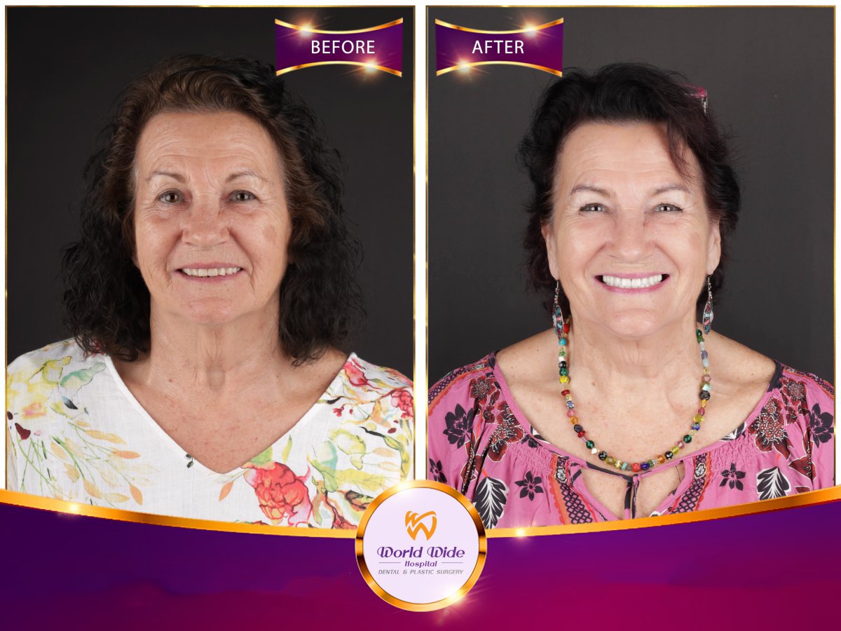 نتيجة قبل وبعد زراعة الأسنان All-on-4 في مستشفى Worldwide Dental & Plastic Surgery