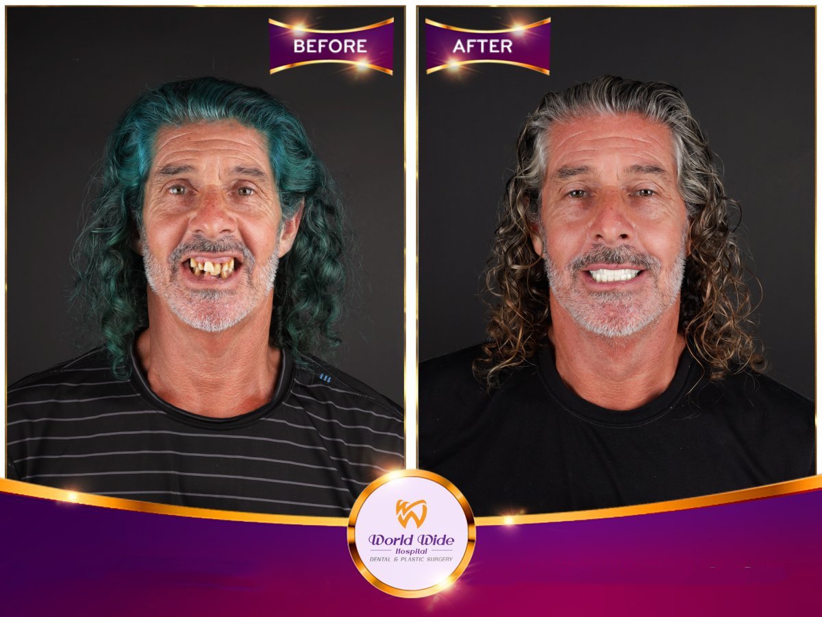 Before and after All-on-4 dental implants result at Worldwide Dental & Plastic Surgery Hospital