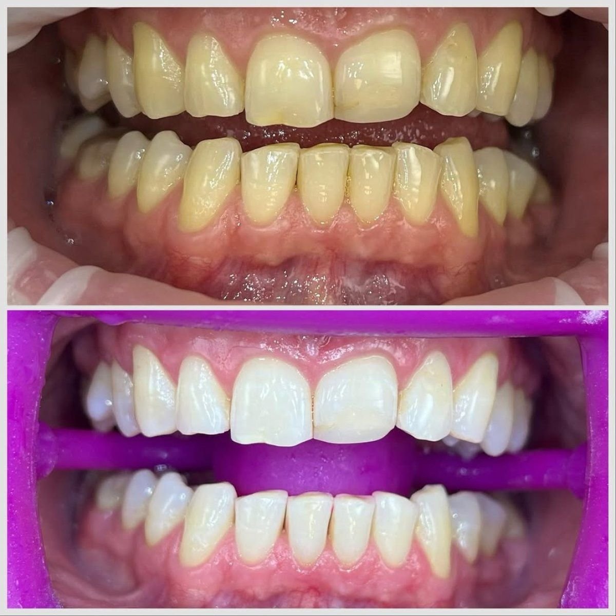 Before and after teeth cleaning (scaling) results at Smile Centrum – visibly whiter teeth