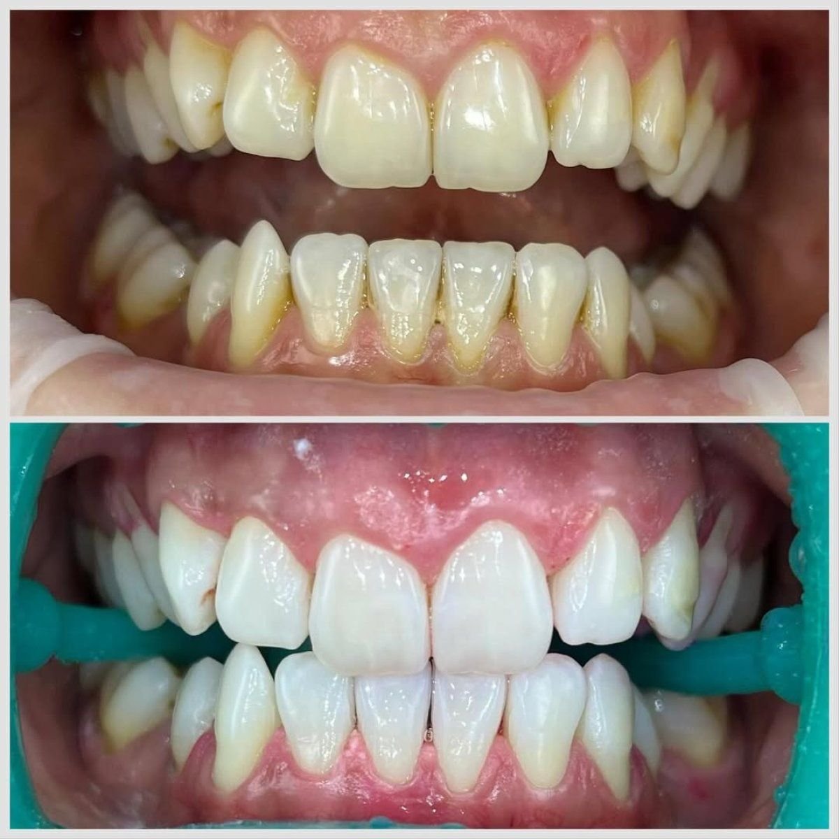 Before and after teeth cleaning (scaling) results at Smile Centrum – visibly whiter teeth