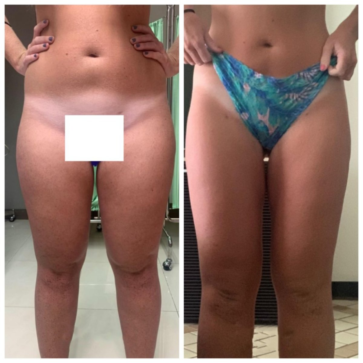 Результаты липосакции до и после в Bangkok Plastic Surgery: стройнее бедра и живот