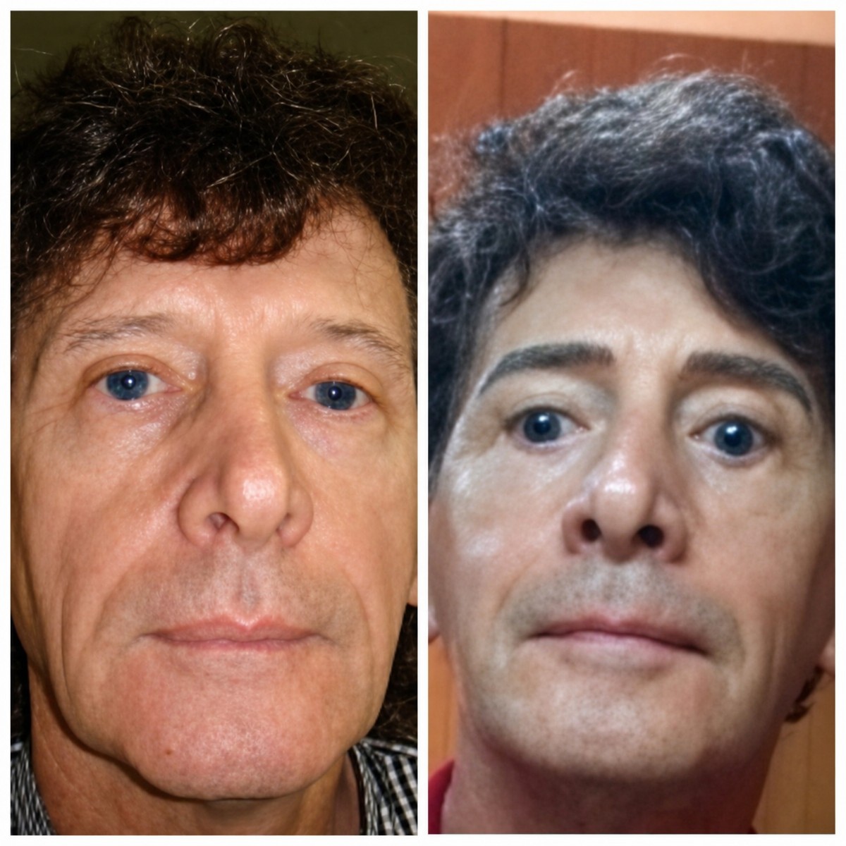 Before and after facelift results at Bangkok Plastic Surgery – visible facial rejuvenation