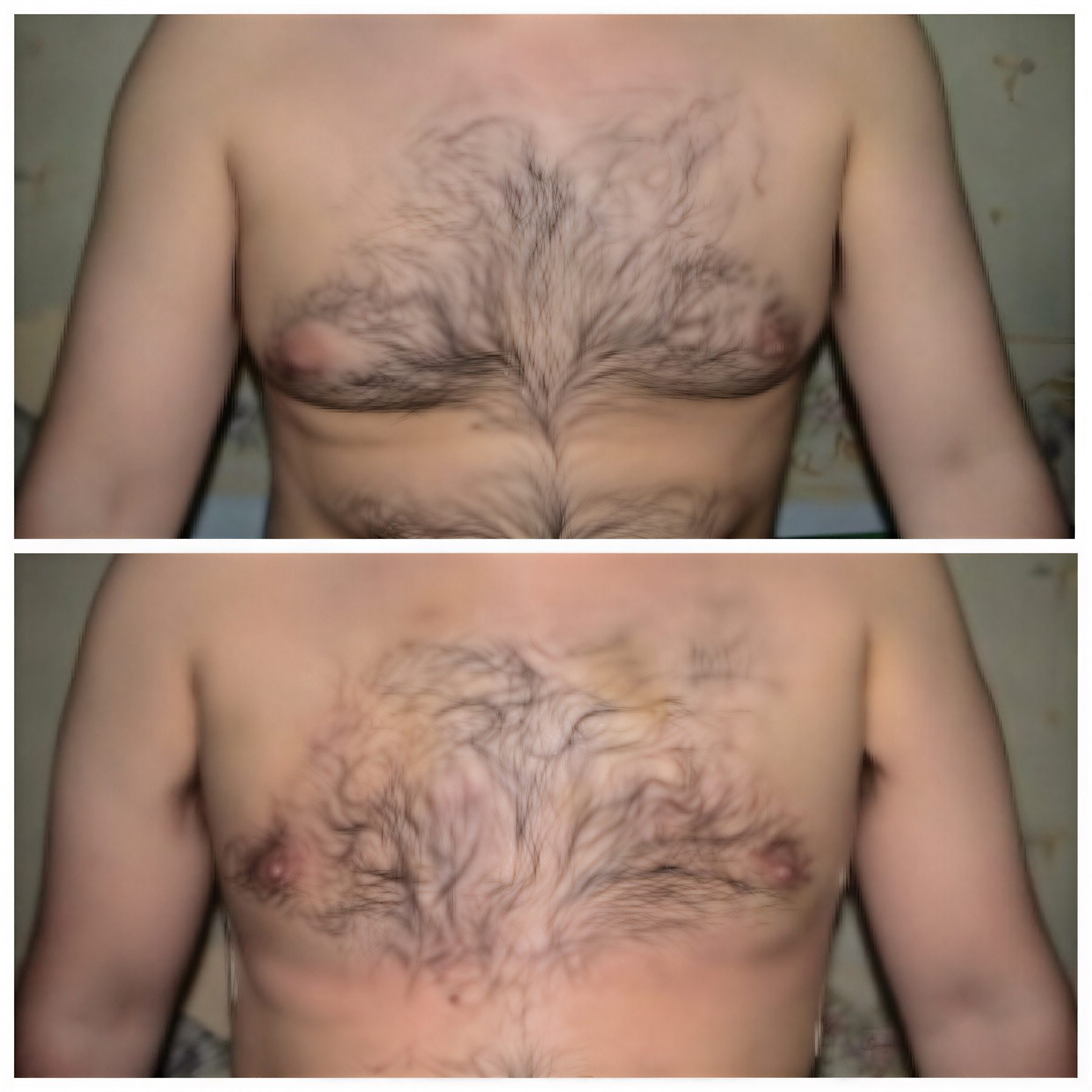 Resultados antes y después de cirugía de ginecomastia en Bangkok Plastic Surgery, contorno masculino