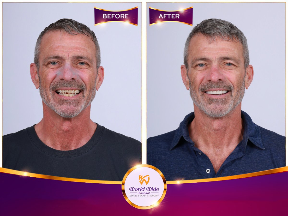 Hollywood Smile before and after results at Worldwide Dental & Plastic Surgery Hospital