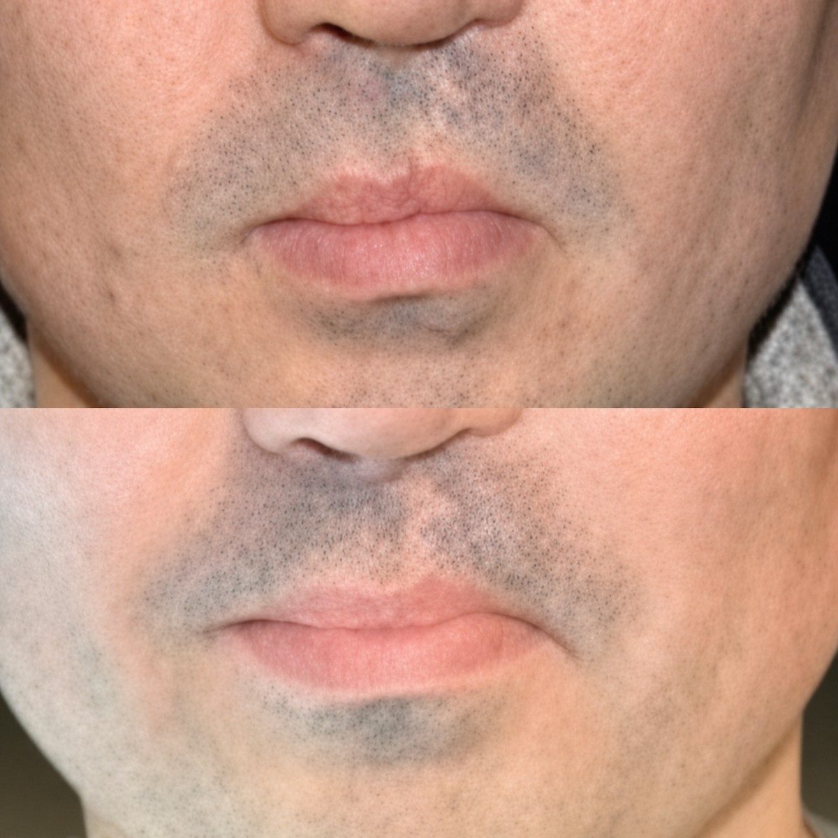 Resultados antes y después de reparación de labio leporino en Memorial Bahçelievler Hospital, forma mejorada