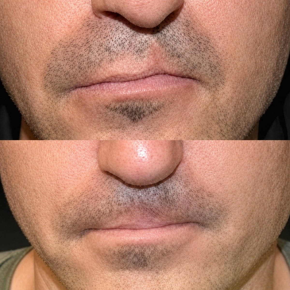 Resultados antes y después de reparación de labio leporino en Memorial Bahçelievler Hospital