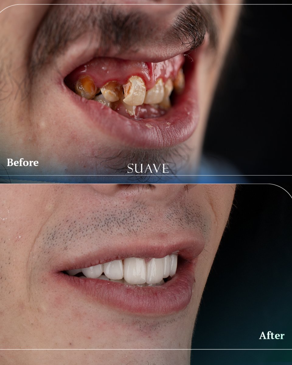 Résultat avant/après pose de couronnes zircone à SUAVE DENTAL CLINIC, sourire restauré