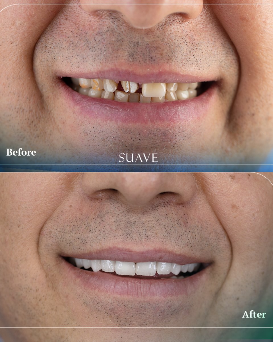 Avant-après pose de couronnes zircone à SUAVE DENTAL CLINIC, résultat sourire