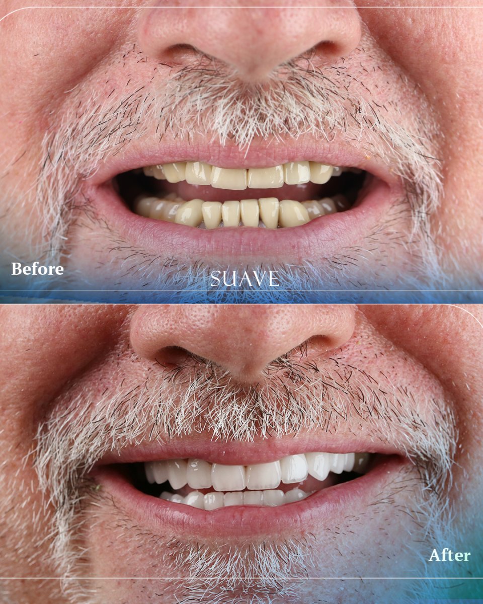 Результаты до и после установки циркониевых коронок в SUAVE DENTAL CLINIC – восстановление улыбки