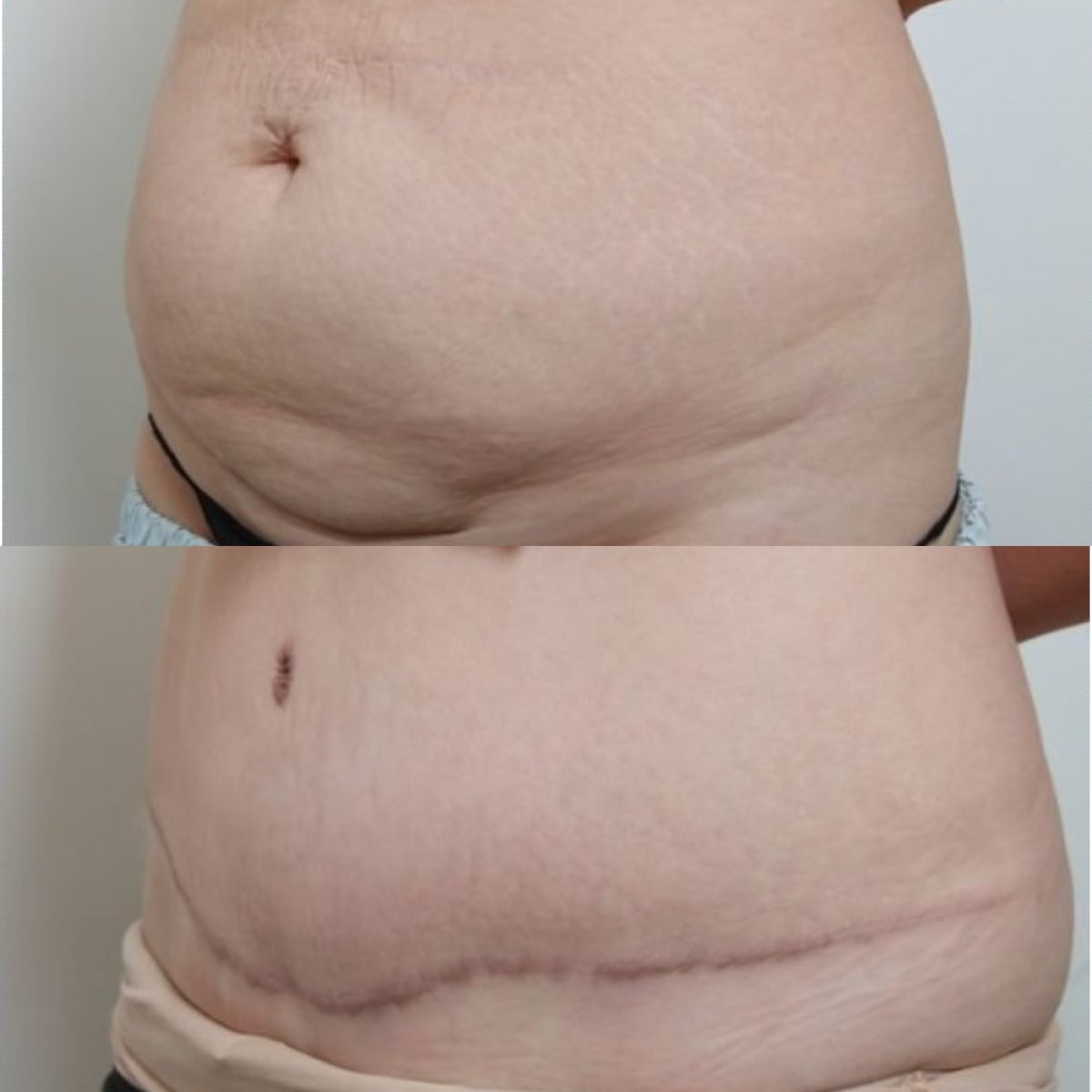 Résultats avant/après mommy makeover à URBAN Plastic Surgery, remodelage abdominal visible