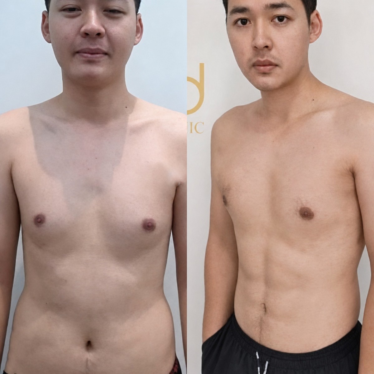 Before and after liposuction results at ID Clinic Bangkok, improved male body contour
