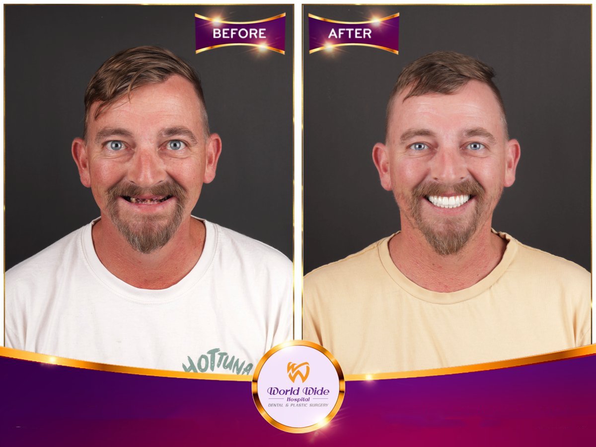 نتيجة زراعة الأسنان All-on-6 قبل وبعد في مستشفى Worldwide Dental & Plastic Surgery