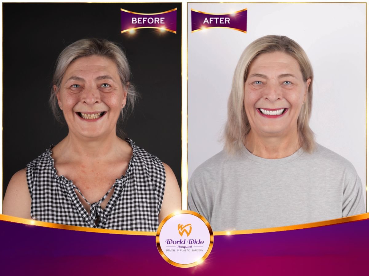 Resultados antes y después de implantes dentales All-on-6 en Worldwide Dental & Plastic Surgery Hospital